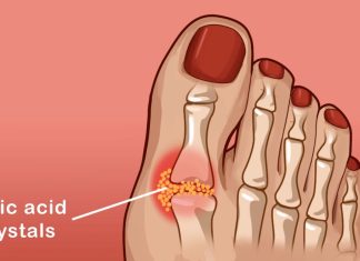 9 potent ways to reduce uric acid naturally