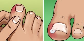 Here’s what causes ingrown toenails and how to get rid of them at home