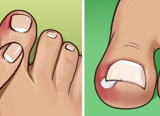 Here’s what causes ingrown toenails and how to get rid of them at home
