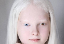 These People’s Genetic Conditions Really Make Them Unique