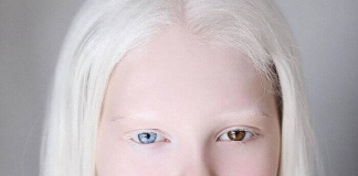 These People’s Genetic Conditions Really Make Them Unique