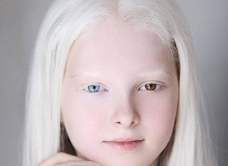 These People’s Genetic Conditions Really Make Them Unique