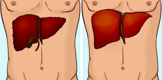 How to spot liver failure and what to do for treatment