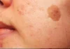 Simple Trick to Remove Brown Spots from Your Skin