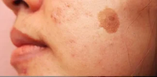Simple Trick to Remove Brown Spots from Your Skin