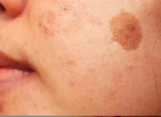 Simple Trick to Remove Brown Spots from Your Skin