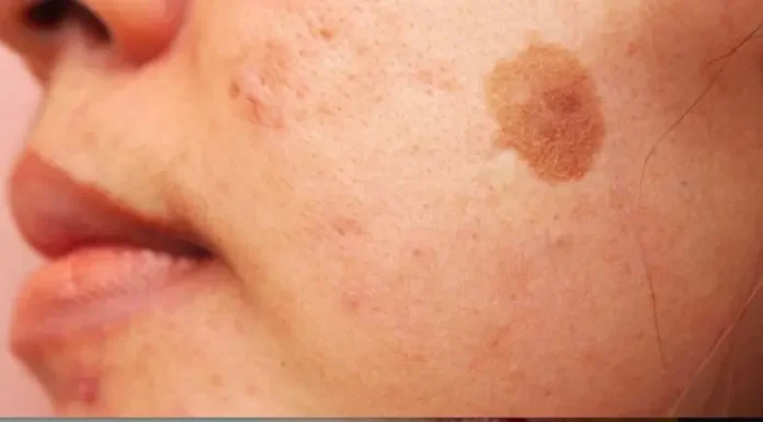 Simple Trick to Remove Brown Spots from Your Skin