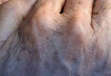 8 Things That Cause Dark Spots on the Hands (and How to Fix Them)