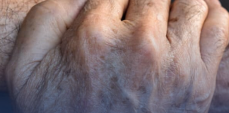 8 Things That Cause Dark Spots on the Hands (and How to Fix Them)