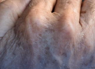 8 Things That Cause Dark Spots on the Hands (and How to Fix Them)