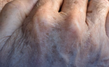 8 Things That Cause Dark Spots on the Hands (and How to Fix Them)