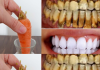 Teeth whitening in just 2 minutes – turning yellow and accumulated tartar into milk-like white and shiny.