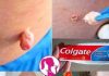 Eliminate Warts, Blackheads, and Age Spots Naturally
