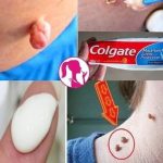 Eliminate Warts, Blackheads, and Age Spots Naturally
