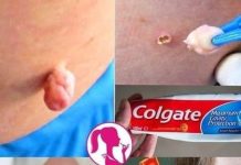 Eliminate Warts, Blackheads, and Age Spots Naturally