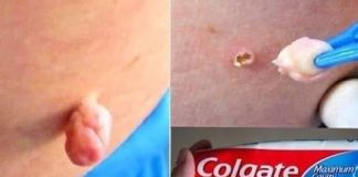 Eliminate Warts, Blackheads, and Age Spots Naturally