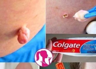Eliminate Warts, Blackheads, and Age Spots Naturally