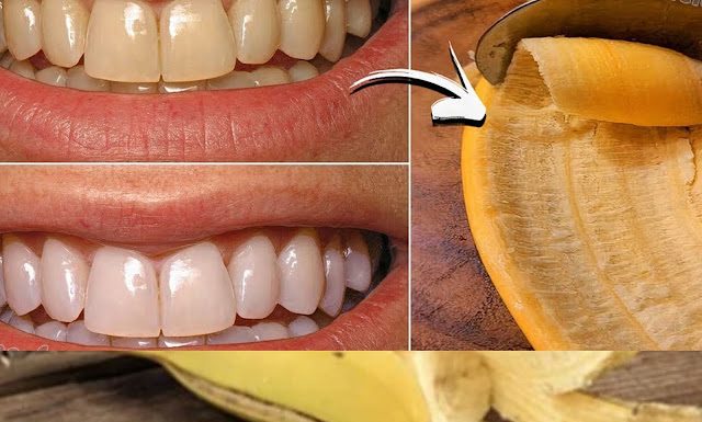 A Brighter Smile with a Simple Secret: The Banana Peel Trick