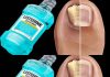 Say Goodbye to Nail Fungus with This Simple Home Remedy