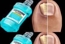 Say Goodbye to Nail Fungus with This Simple Home Remedy