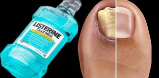 Say Goodbye to Nail Fungus with This Simple Home Remedy