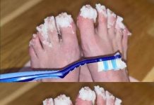 If you have nail fungus try this natural remedy: it disappears quickly