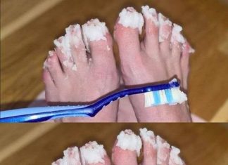 If you have nail fungus try this natural remedy: it disappears quickly