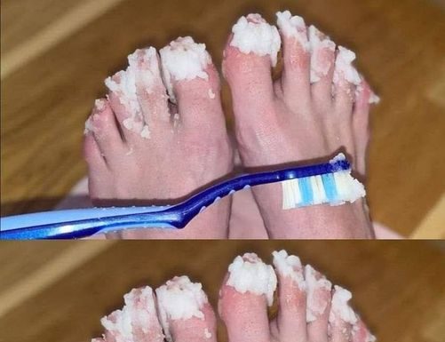 If you have nail fungus try this natural remedy: it disappears quickly