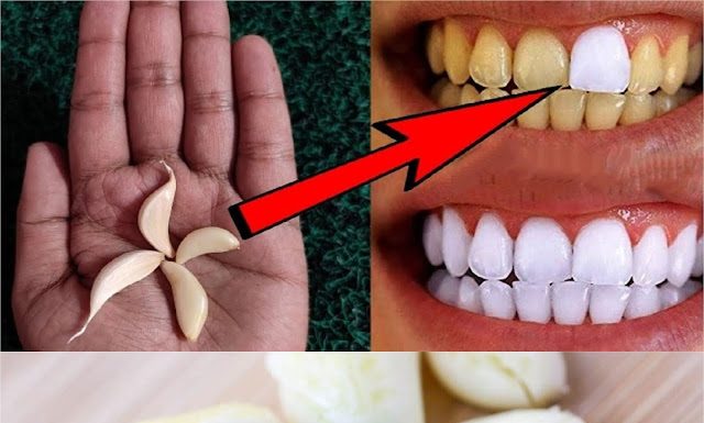 Unlock the Secret to a Brighter Smile with Garlic