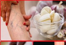 Leg pain, rheumatism, varicose veins, arthritis, headache, joint pain. Mother’s natural remedy.