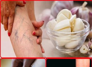 Leg pain, rheumatism, varicose veins, arthritis, headache, joint pain. Mother’s natural remedy.