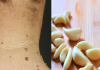Say Goodbye to Skin Tags with Garlic