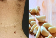 Say Goodbye to Skin Tags with Garlic