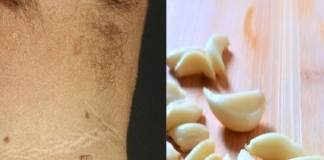 Say Goodbye to Skin Tags with Garlic