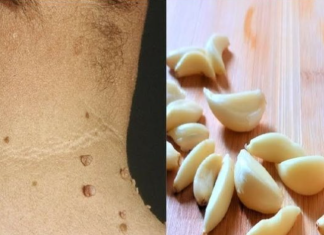 Say Goodbye to Skin Tags with Garlic