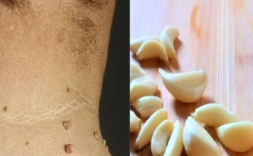 Say Goodbye to Skin Tags with Garlic