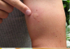 Goodbye Mosquitoes: Natural and Effective Strategies to Eliminate Flies