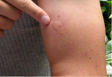 Goodbye Mosquitoes: Natural and Effective Strategies to Eliminate Flies