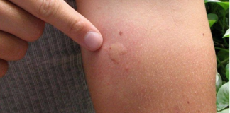 Goodbye Mosquitoes: Natural and Effective Strategies to Eliminate Flies