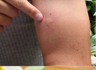 Goodbye Mosquitoes: Natural and Effective Strategies to Eliminate Flies