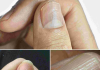 Understanding the Real Causes of Vertical Ridges on Your Nails