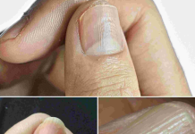 Understanding the Real Causes of Vertical Ridges on Your Nails