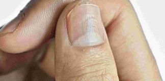 Understanding the Real Causes of Vertical Ridges on Your Nails