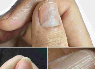 Understanding the Real Causes of Vertical Ridges on Your Nails