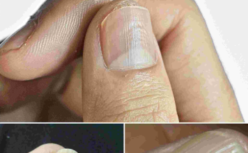 Understanding the Real Causes of Vertical Ridges on Your Nails
