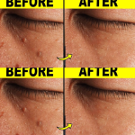 9 Effective Ways to Remove Skin Tags at Home
