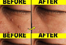 9 Effective Ways to Remove Skin Tags at Home