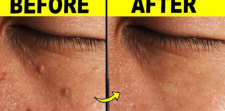 9 Effective Ways to Remove Skin Tags at Home