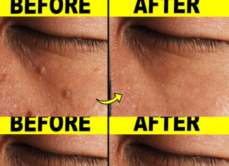 9 Effective Ways to Remove Skin Tags at Home