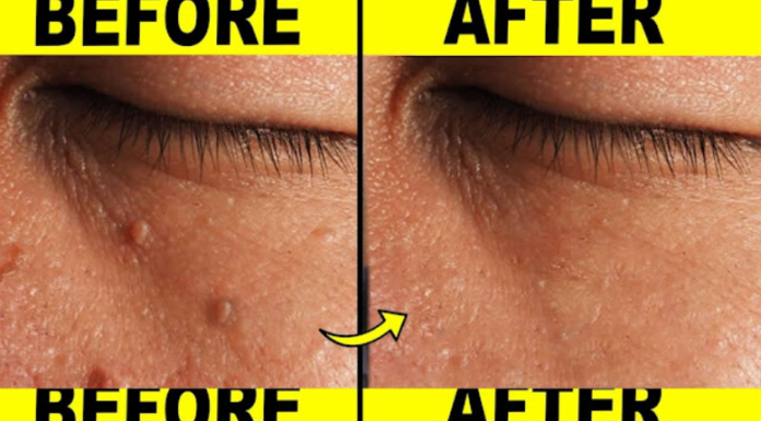 9 Effective Ways to Remove Skin Tags at Home